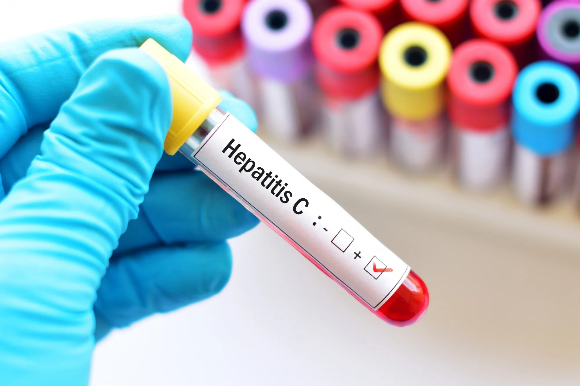 Hepatitis Treatment Changes