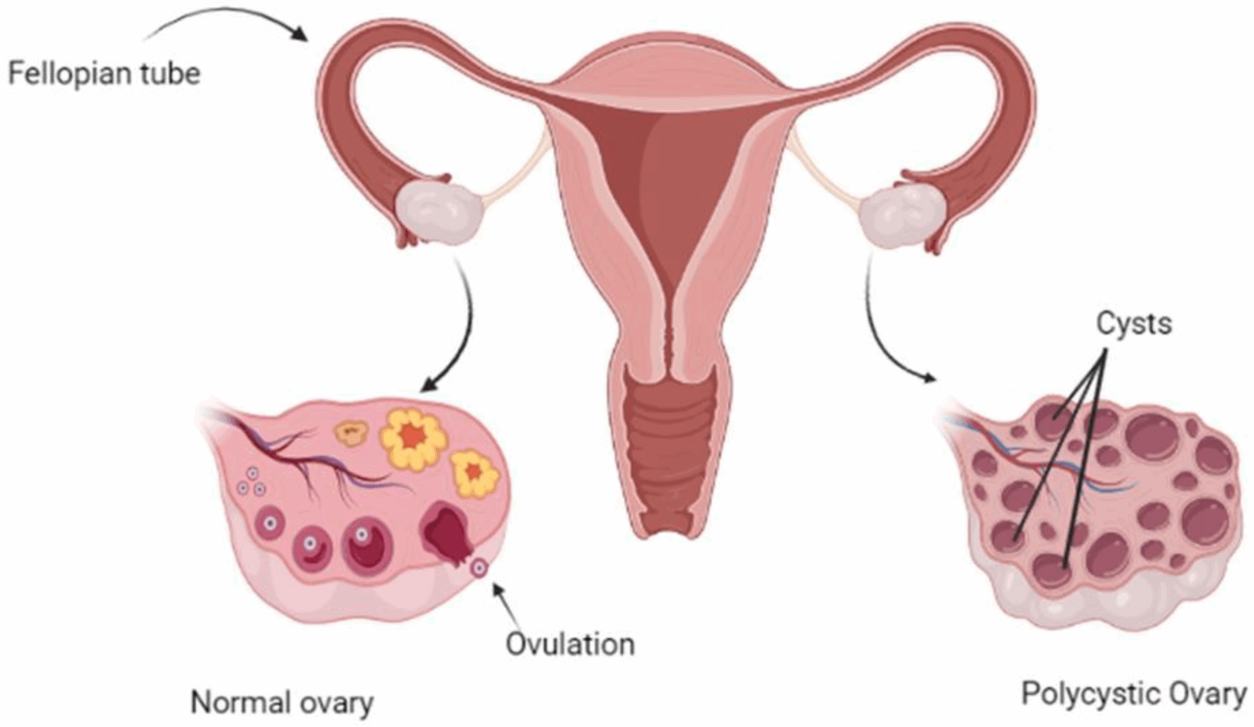Ovary-Syndrome-Progression-scaled