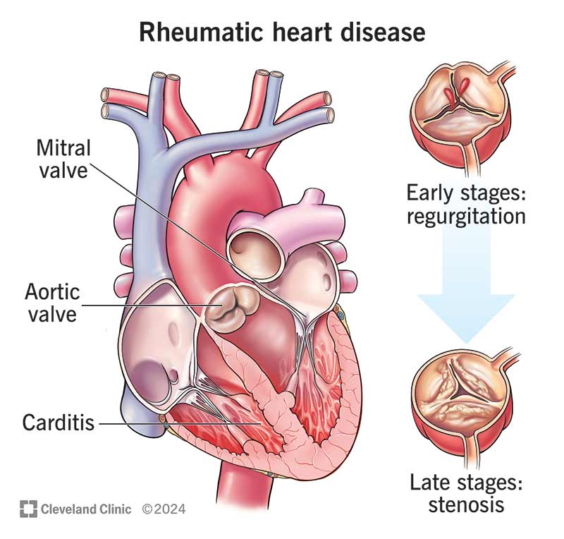 Rheumatic Carditis Diagnosis
