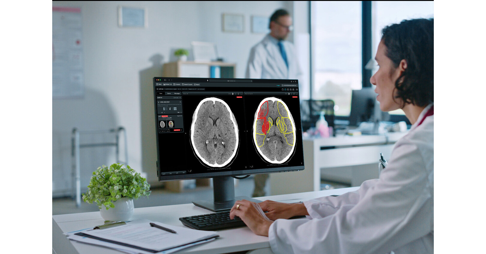 Brainomix Stroke AI Software