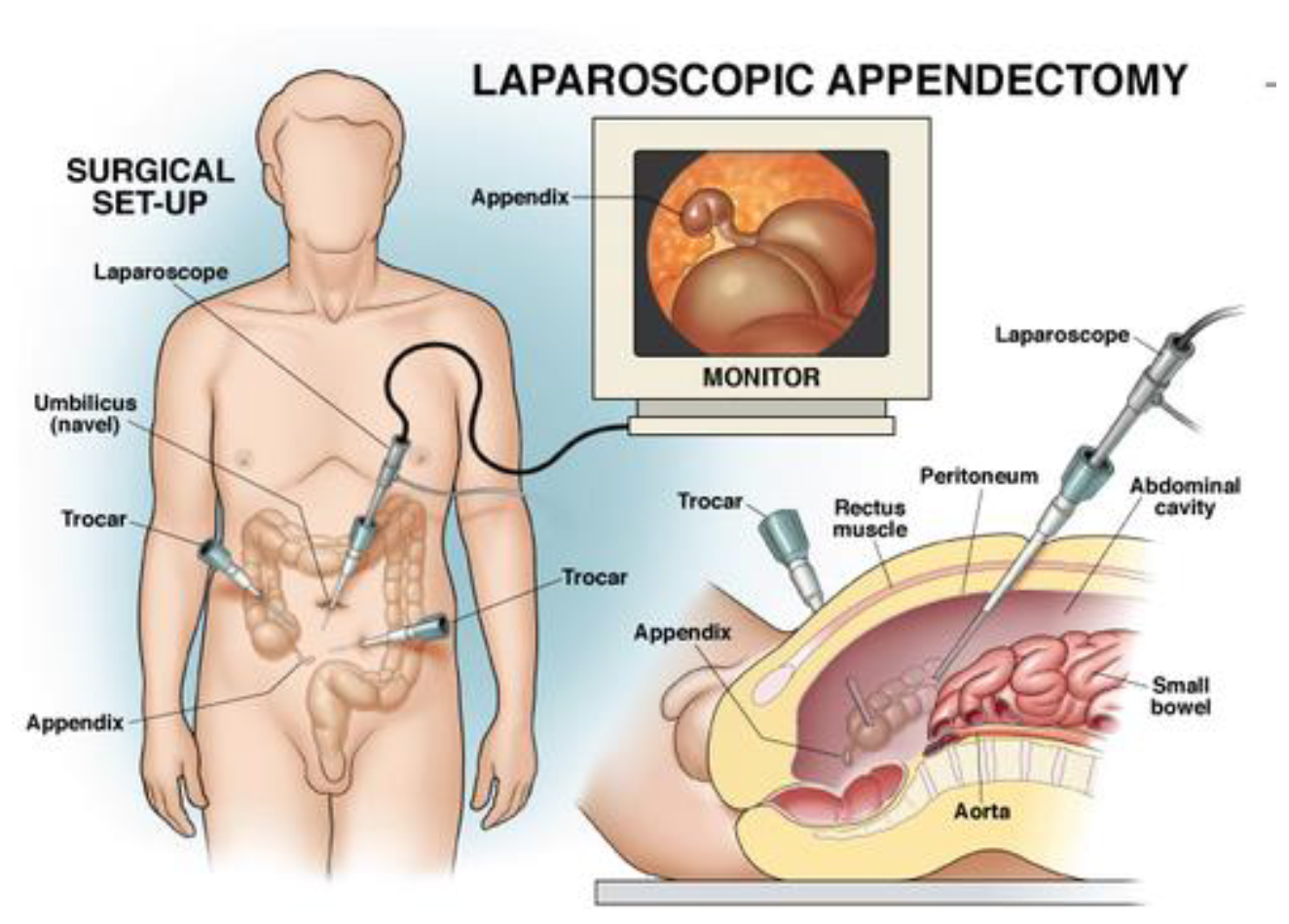 Laparoscopic vs Open Appendectomy