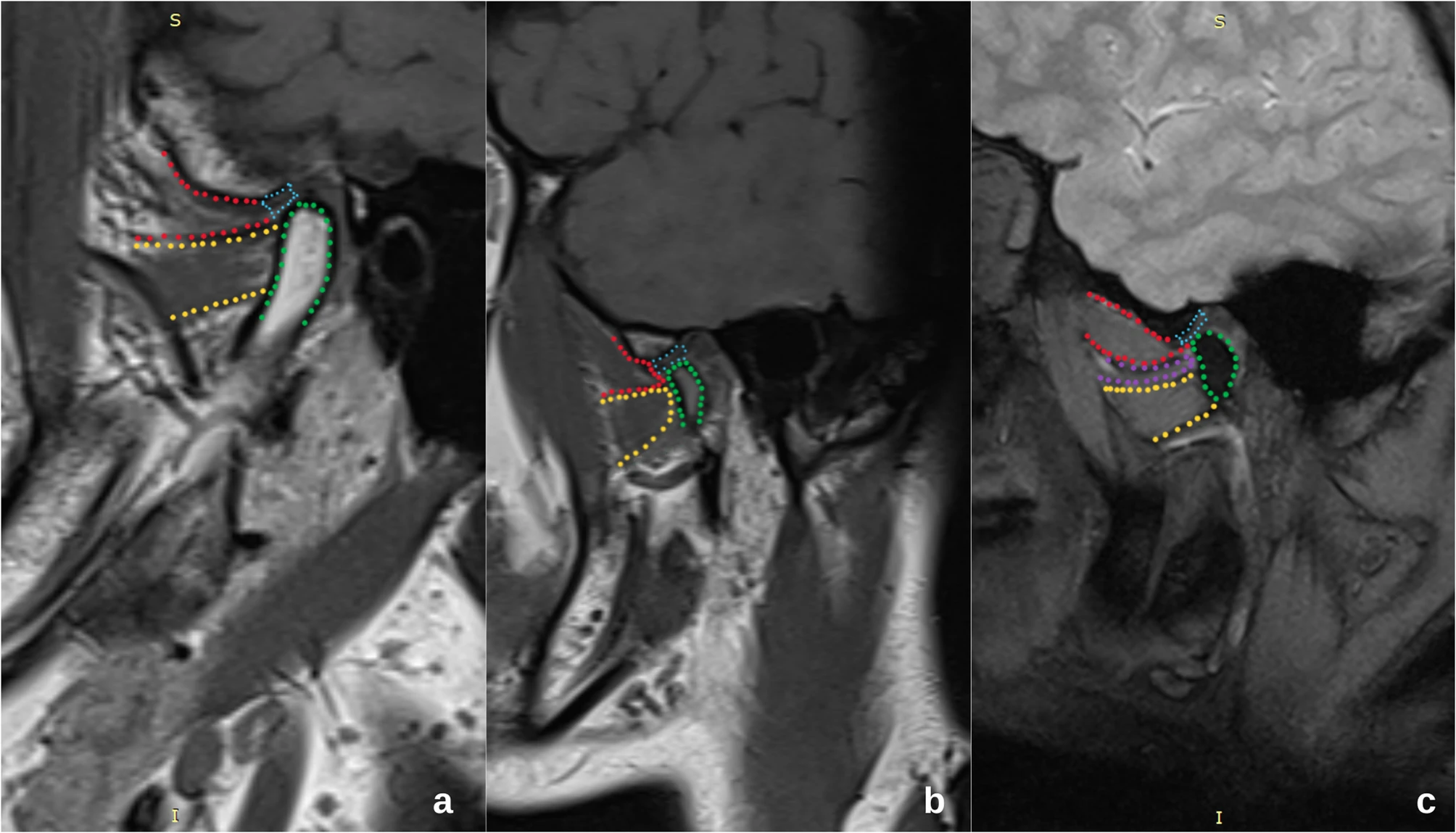 Assessing Articular Disc Displacement